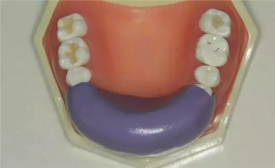 硅橡膠導(dǎo)板——牙體預(yù)備步驟詳解 硅橡膠導(dǎo)板——牙體預(yù)備步驟詳解