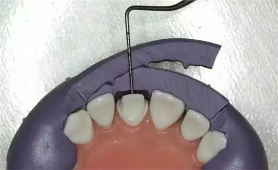 硅橡膠導(dǎo)板——牙體預(yù)備步驟詳解 硅橡膠導(dǎo)板——牙體預(yù)備步驟詳解