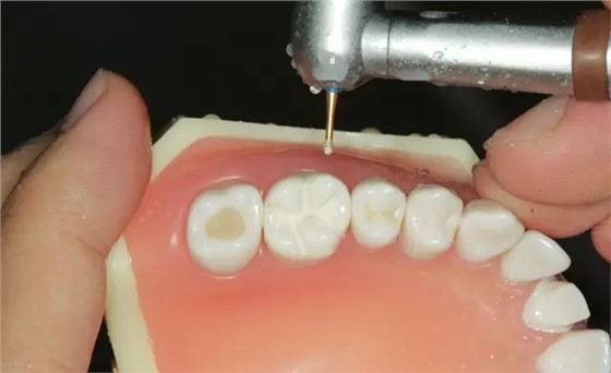 硅橡膠導(dǎo)板——牙體預(yù)備步驟詳解 硅橡膠導(dǎo)板——牙體預(yù)備步驟詳解