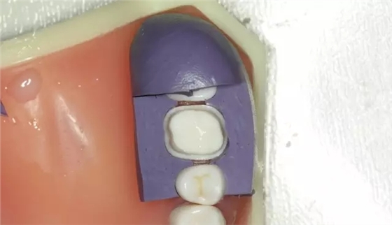 硅橡膠導(dǎo)板——牙體預(yù)備步驟詳解 硅橡膠導(dǎo)板——牙體預(yù)備步驟詳解