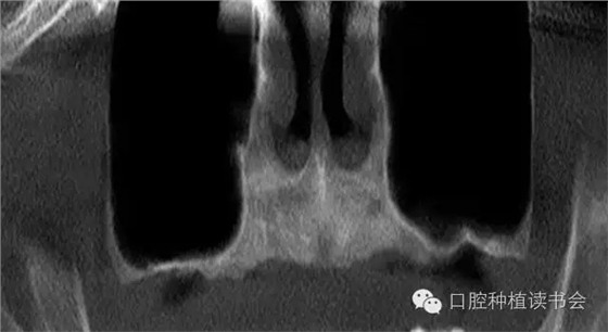 上頜后牙區(qū)種植治療的關(guān)鍵技術(shù)之—上頜竇提升術(shù)