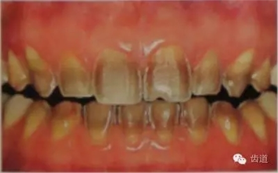 瓷貼面的粘接步驟及技術(shù)要點(diǎn) 瓷貼面的粘接步驟及技術(shù)要點(diǎn)