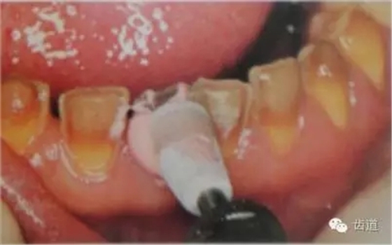 瓷貼面的粘接步驟及技術(shù)要點(diǎn) 瓷貼面的粘接步驟及技術(shù)要點(diǎn)