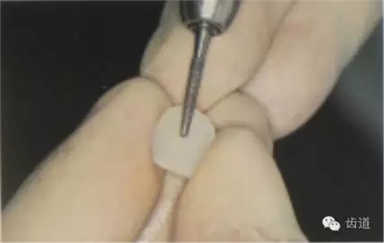 瓷貼面的粘接步驟及技術(shù)要點(diǎn) 瓷貼面的粘接步驟及技術(shù)要點(diǎn)