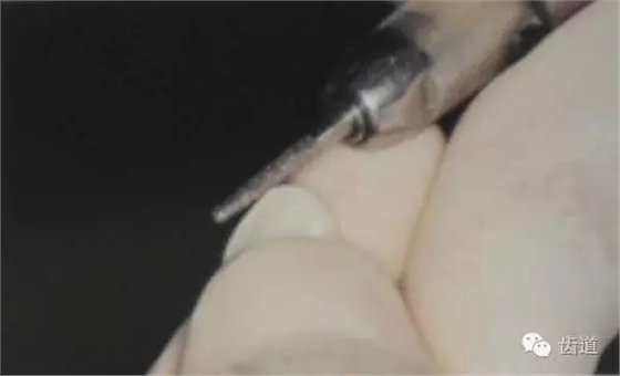 瓷貼面的粘接步驟及技術(shù)要點(diǎn) 瓷貼面的粘接步驟及技術(shù)要點(diǎn)