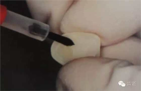 瓷貼面的粘接步驟及技術(shù)要點(diǎn) 瓷貼面的粘接步驟及技術(shù)要點(diǎn)