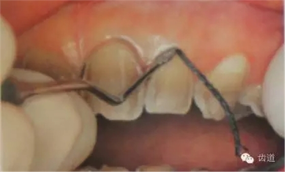 瓷貼面的粘接步驟及技術(shù)要點(diǎn) 瓷貼面的粘接步驟及技術(shù)要點(diǎn)