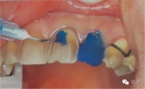 瓷貼面的粘接步驟及技術(shù)要點(diǎn) 瓷貼面的粘接步驟及技術(shù)要點(diǎn)