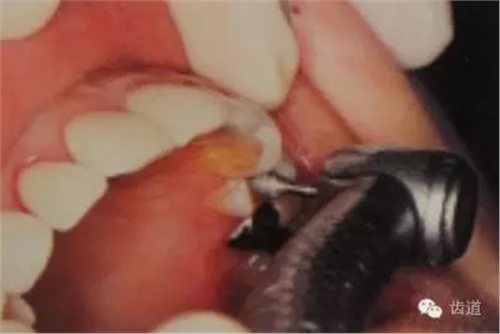 瓷貼面的粘接步驟及技術(shù)要點(diǎn) 瓷貼面的粘接步驟及技術(shù)要點(diǎn)