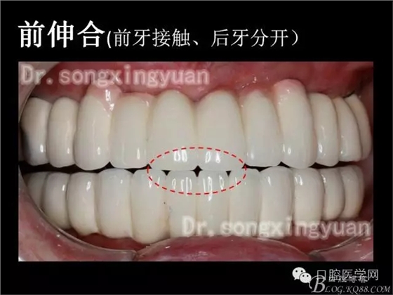 種植牙全口咬合重建