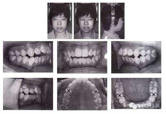 拔牙矯治開頜伴前突 拔牙矯治開頜伴前突
