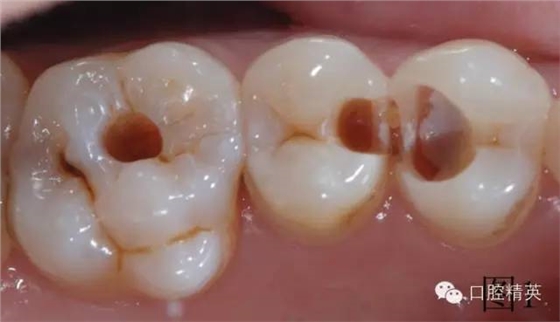 橡皮障在樹脂充填的應(yīng)用 橡皮障在樹脂充填的應(yīng)用