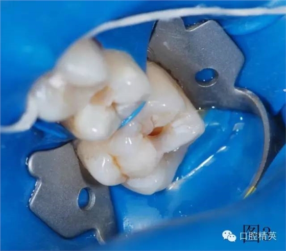 橡皮障在樹脂充填的應(yīng)用 橡皮障在樹脂充填的應(yīng)用