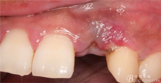 【征文大賽】一例上前牙種植失敗病例的補(bǔ)救--梁光強(qiáng) 【征文大賽】一例上前牙種植失敗病例的補(bǔ)救--梁光強(qiáng)