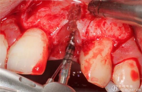 【征文大賽】一例上前牙種植失敗病例的補(bǔ)救--梁光強(qiáng) 【征文大賽】一例上前牙種植失敗病例的補(bǔ)救--梁光強(qiáng)