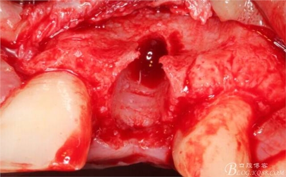 【征文大賽】一例上前牙種植失敗病例的補(bǔ)救--梁光強(qiáng) 【征文大賽】一例上前牙種植失敗病例的補(bǔ)救--梁光強(qiáng)