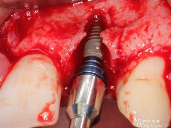 【征文大賽】一例上前牙種植失敗病例的補(bǔ)救--梁光強(qiáng) 【征文大賽】一例上前牙種植失敗病例的補(bǔ)救--梁光強(qiáng)