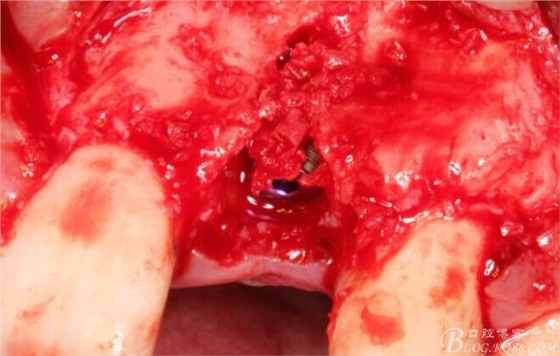 【征文大賽】一例上前牙種植失敗病例的補(bǔ)救--梁光強(qiáng) 【征文大賽】一例上前牙種植失敗病例的補(bǔ)救--梁光強(qiáng)