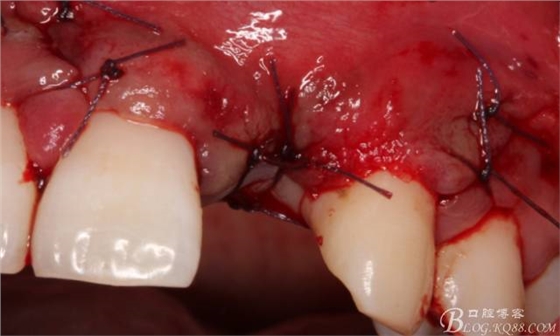 【征文大賽】一例上前牙種植失敗病例的補(bǔ)救--梁光強(qiáng) 【征文大賽】一例上前牙種植失敗病例的補(bǔ)救--梁光強(qiáng)