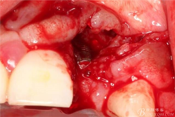 【征文大賽】一例上前牙種植失敗病例的補(bǔ)救--梁光強(qiáng) 【征文大賽】一例上前牙種植失敗病例的補(bǔ)救--梁光強(qiáng)