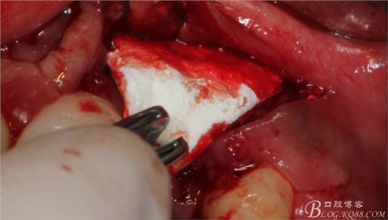 【征文大賽】一例上前牙種植失敗病例的補(bǔ)救--梁光強(qiáng) 【征文大賽】一例上前牙種植失敗病例的補(bǔ)救--梁光強(qiáng)