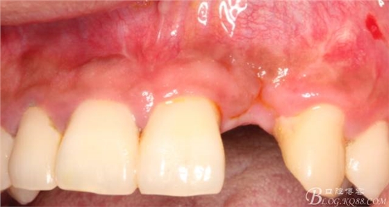 【征文大賽】一例上前牙種植失敗病例的補(bǔ)救--梁光強(qiáng) 【征文大賽】一例上前牙種植失敗病例的補(bǔ)救--梁光強(qiáng)