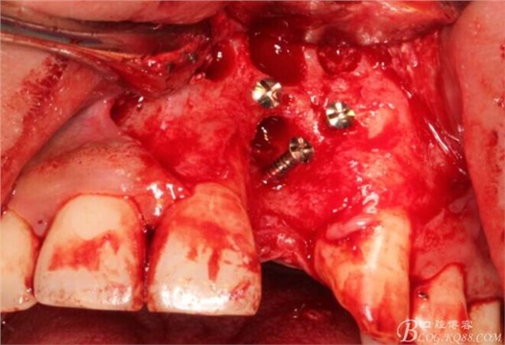 【征文大賽】一例上前牙種植失敗病例的補(bǔ)救--梁光強(qiáng) 【征文大賽】一例上前牙種植失敗病例的補(bǔ)救--梁光強(qiáng)