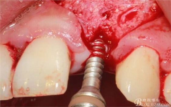 【征文大賽】一例上前牙種植失敗病例的補(bǔ)救--梁光強(qiáng) 【征文大賽】一例上前牙種植失敗病例的補(bǔ)救--梁光強(qiáng)
