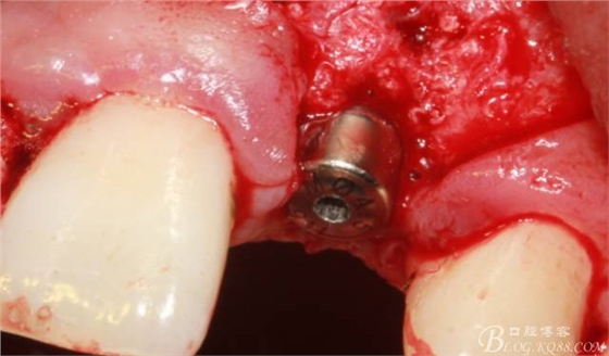 【征文大賽】一例上前牙種植失敗病例的補(bǔ)救--梁光強(qiáng) 【征文大賽】一例上前牙種植失敗病例的補(bǔ)救--梁光強(qiáng)