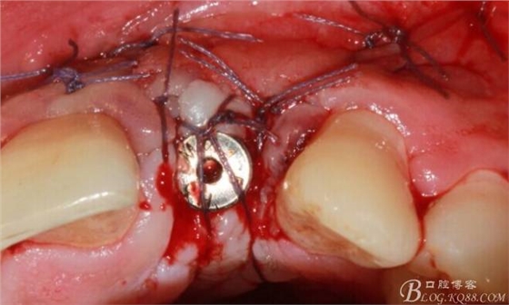 【征文大賽】一例上前牙種植失敗病例的補(bǔ)救--梁光強(qiáng) 【征文大賽】一例上前牙種植失敗病例的補(bǔ)救--梁光強(qiáng)