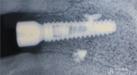 【征文大賽】一例上前牙種植失敗病例的補(bǔ)救--梁光強(qiáng) 【征文大賽】一例上前牙種植失敗病例的補(bǔ)救--梁光強(qiáng)