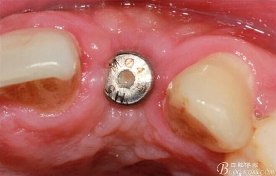 【征文大賽】一例上前牙種植失敗病例的補(bǔ)救--梁光強(qiáng) 【征文大賽】一例上前牙種植失敗病例的補(bǔ)救--梁光強(qiáng)