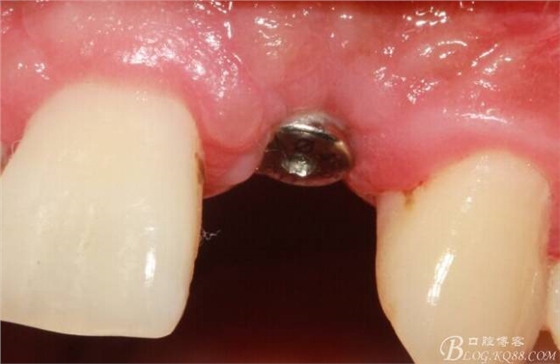 【征文大賽】一例上前牙種植失敗病例的補(bǔ)救--梁光強(qiáng) 【征文大賽】一例上前牙種植失敗病例的補(bǔ)救--梁光強(qiáng)