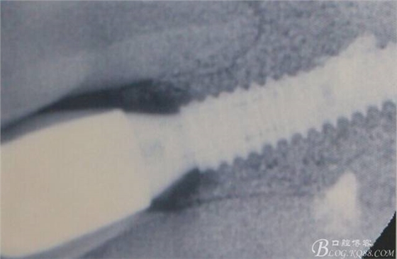 【征文大賽】一例上前牙種植失敗病例的補(bǔ)救--梁光強(qiáng) 【征文大賽】一例上前牙種植失敗病例的補(bǔ)救--梁光強(qiáng)