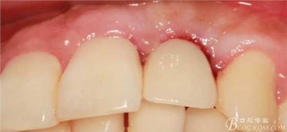 【征文大賽】一例上前牙種植失敗病例的補(bǔ)救--梁光強(qiáng) 【征文大賽】一例上前牙種植失敗病例的補(bǔ)救--梁光強(qiáng)