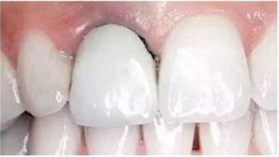 烤瓷牙邊緣變黑，要換新的嗎？