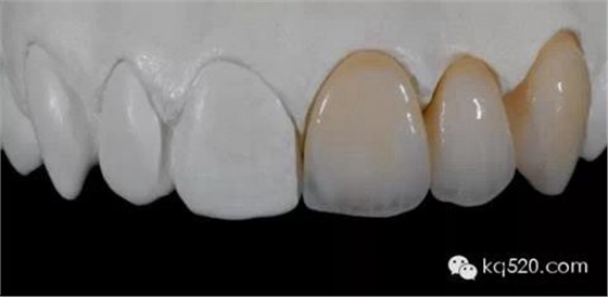 烤瓷牙邊緣變黑，要換新的嗎？