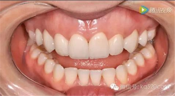 烤瓷牙邊緣變黑，要換新的嗎？