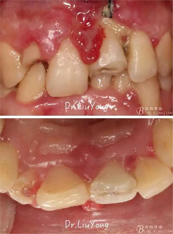 山西牙周劉勇：“前牙外傷患者的口腔多學科聯(lián)合治療”精彩案例分享