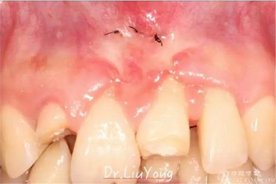 山西牙周劉勇：“前牙外傷患者的口腔多學科聯(lián)合治療”精彩案例分享