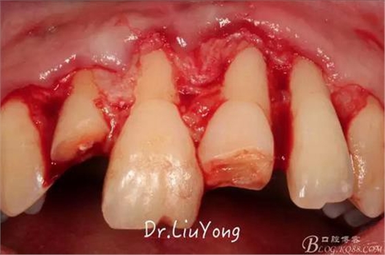 山西牙周劉勇：“前牙外傷患者的口腔多學科聯(lián)合治療”精彩案例分享