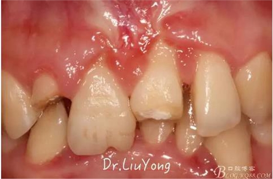 山西牙周劉勇：“前牙外傷患者的口腔多學科聯(lián)合治療”精彩案例分享