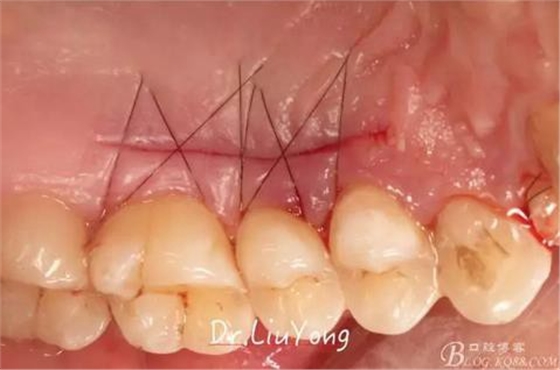 3山西牙周劉勇：“前牙外傷患者的口腔多學科聯(lián)合治療”精彩案例分享