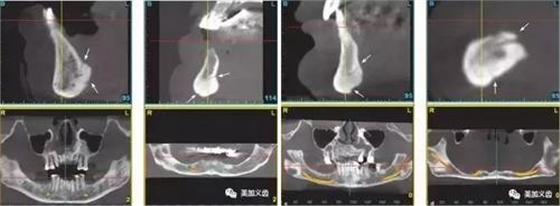 牙醫(yī)引以為戒——日本植牙手術(shù)死亡事件 牙醫(yī)引以為戒——日本植牙手術(shù)死亡事件