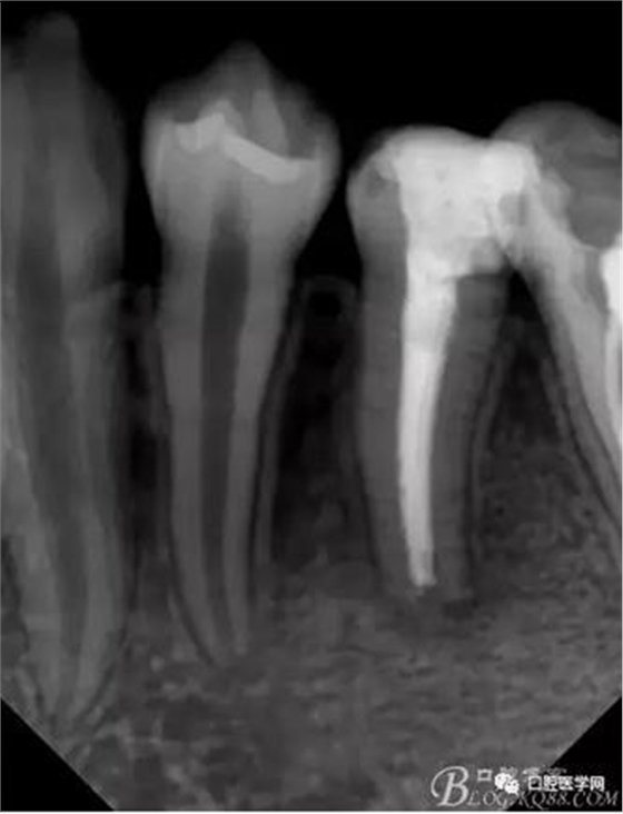 年輕恒牙之根尖誘導術(shù) 年輕恒牙之根尖誘導術(shù)