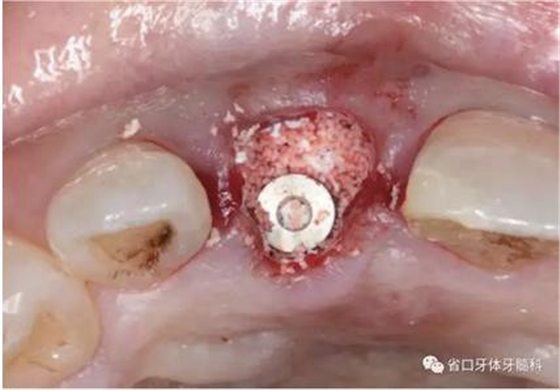 右上前牙即刻種植即刻修復(fù)1例 右上前牙即刻種植即刻修復(fù)1例