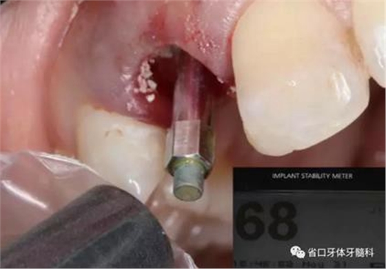 右上前牙即刻種植即刻修復(fù)1例 右上前牙即刻種植即刻修復(fù)1例