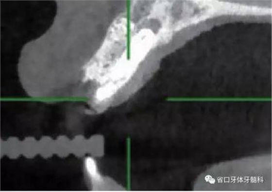右上前牙即刻種植即刻修復(fù)1例 右上前牙即刻種植即刻修復(fù)1例