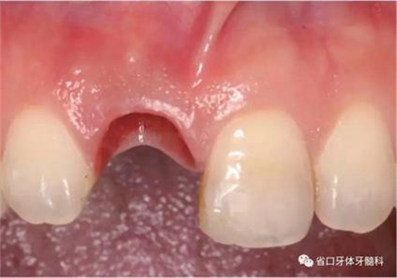 右上前牙即刻種植即刻修復(fù)1例 右上前牙即刻種植即刻修復(fù)1例