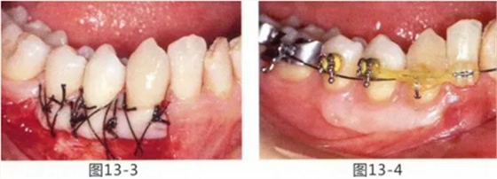 FGG法增大附著齦及根面覆蓋【牙齦-牙槽黏膜的問題】 FGG法增大附著齦及根面覆蓋【牙齦-牙槽黏膜的問題】